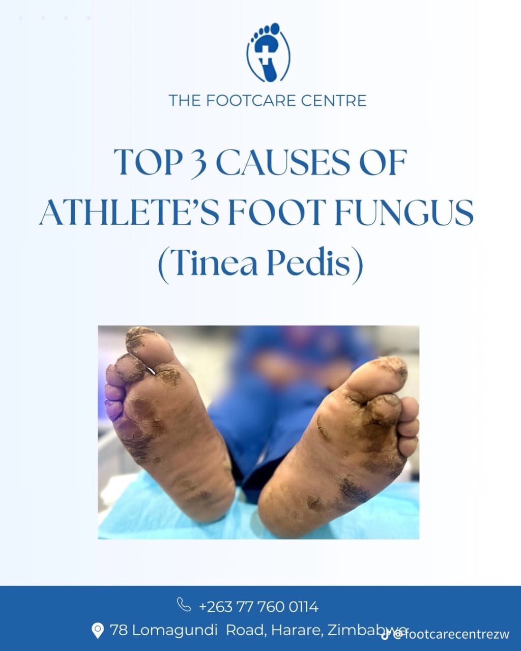 Athletes Foot Fungus