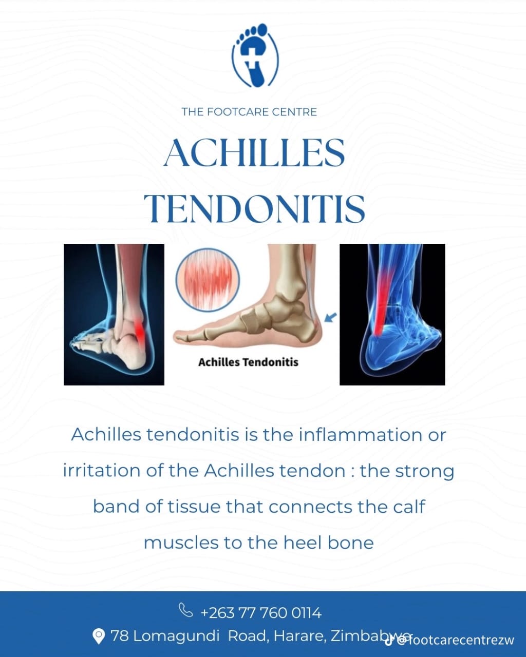 Achilles Tendonitis
